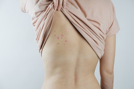 Bed bug bites on the back of a person